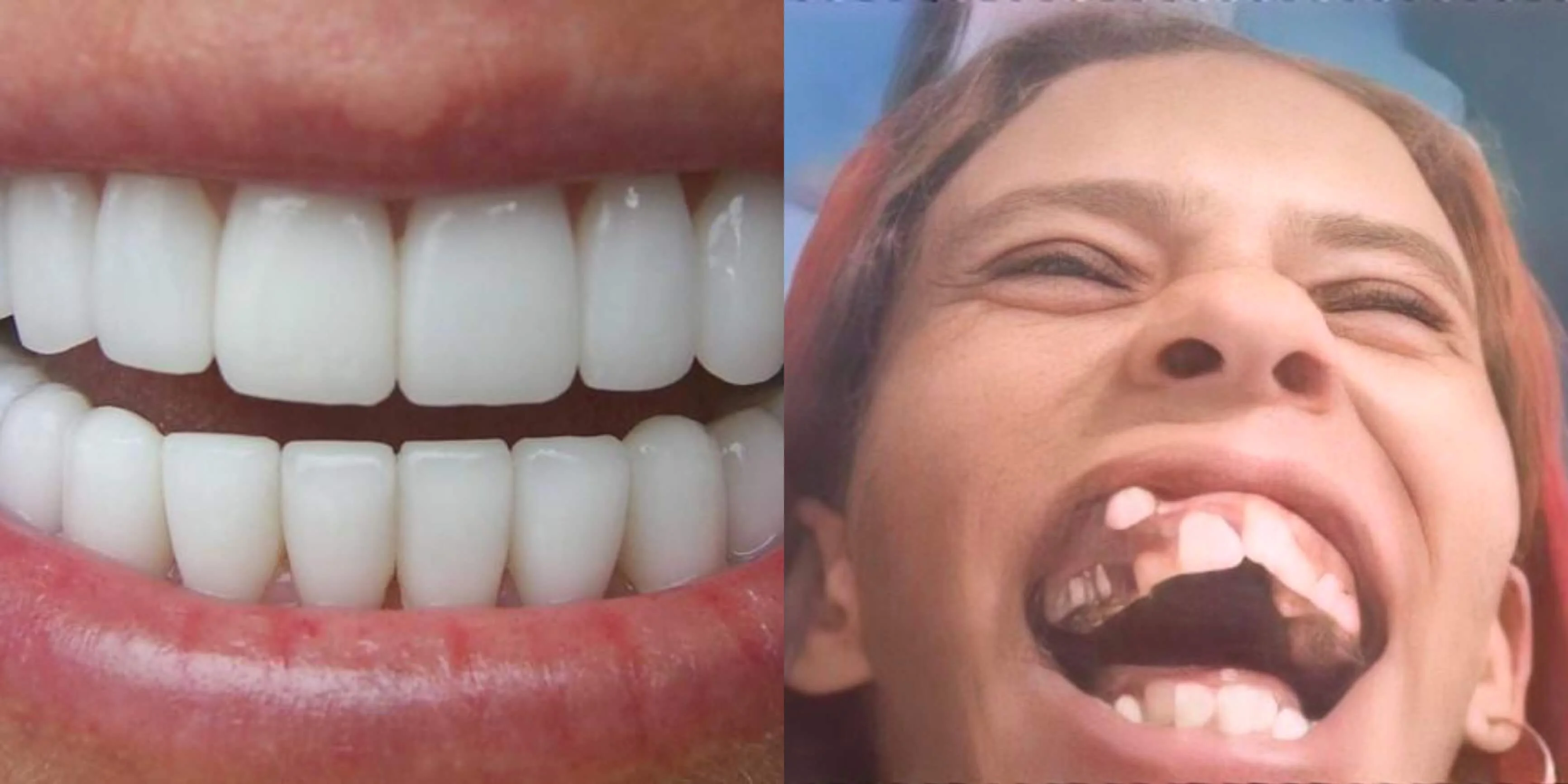 Plantilla de Dientes perfectos | Dientes imperfectos numero 2